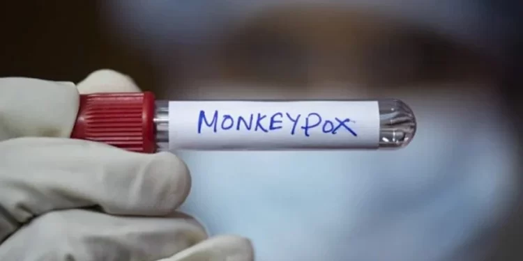 Homem é diagnosticado com HIV, covid e varíola dos macacos na Itália