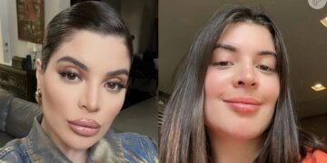 Gkay retira o preenchimento labial e recebe elogios