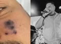 Cantor morre após ser picado por aranha e rosto começar a escurecer, diz família