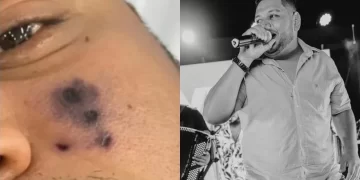 Cantor morre após ser picado por aranha e rosto começar a escurecer, diz família