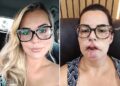 Influenciadora perde os lábios após harmonização facial: “fui enganada”