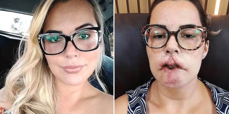 Influenciadora perde os lábios após harmonização facial: “fui enganada”
