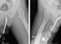 Homem passa por cirurgia para retirar escova de dentes presa em genitália