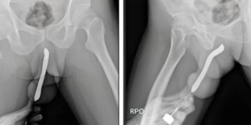 Homem passa por cirurgia para retirar escova de dentes presa em genitália