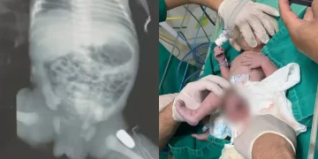 Grávida é atingida por tiro que ficou alojado na perna do bebê no Maranhão