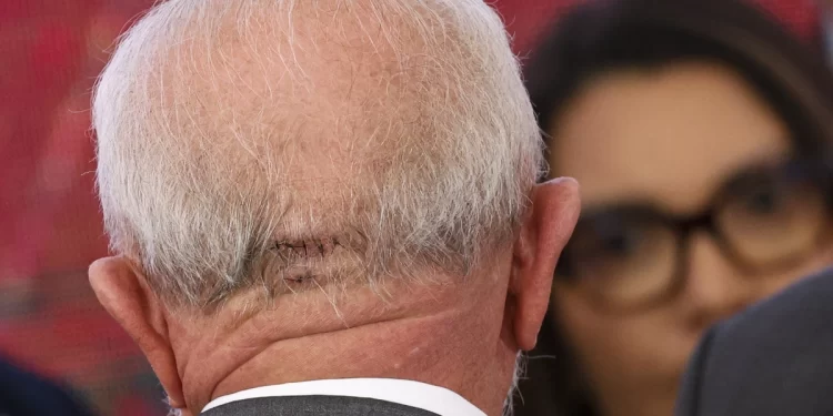 Lula tem hemorragia intracraniana e está na UTI do Hospital Sírio-Libanês