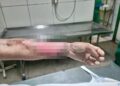 Vendedora sofre graves queimaduras em acidente com gás de cozinha em Parnaíba