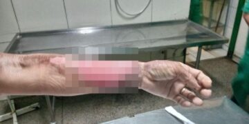 Vendedora sofre graves queimaduras em acidente com gás de cozinha em Parnaíba