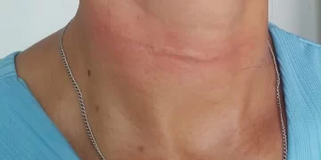 Professora quase é degolada por linha de cerol ao sair para trabalhar em Barras
