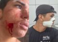 Jovem fica ferido no rosto ao ser atingido por linha de pipa no Piauí