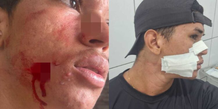 Jovem fica ferido no rosto ao ser atingido por linha de pipa no Piauí