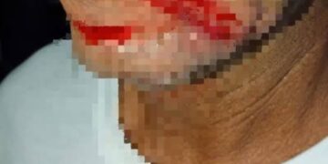 Padeiro fica ferido após fio solto enroscar no pescoço em Teresina
