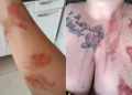 Panela de pressão explode e deixa mulher ferida no interior do Piauí