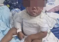 Criança tem corpo queimado em acidente doméstico em cidade do Piauí