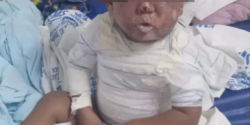 Criança tem corpo queimado em acidente doméstico em cidade do Piauí