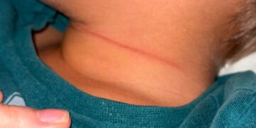 Menino de 4 anos tem pescoço cortado ao ser atingido por linha com cerol